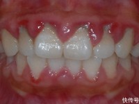 关注牙龈出血和牙齿松动，预防牙周疾病2023