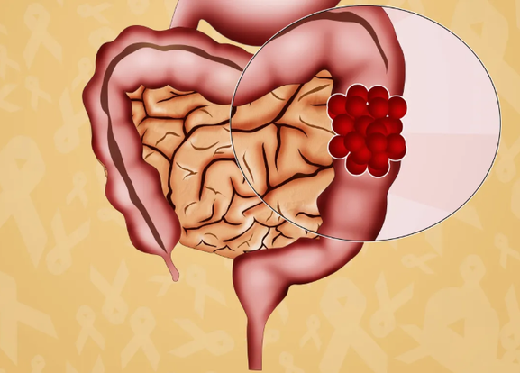 直肠癌前病变是什么意思(关于结直肠癌前病变，高危人群要提高警惕 | 全国肿瘤防治宣传周)