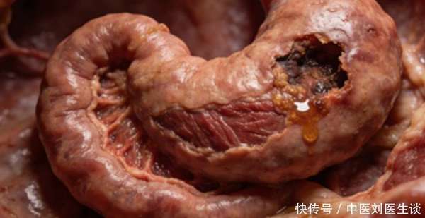 胃溃疡反复发作怎么办(医生提醒：胃溃疡反复发作，3种习惯要改掉，避免病情加重)