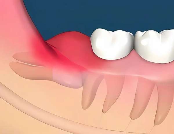 长了智齿一定需要拔掉吗？