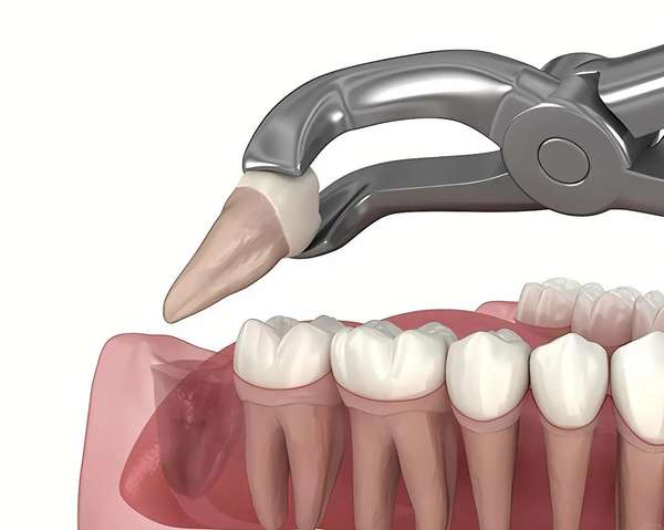 牙齿矫正一定要拔智齿吗？