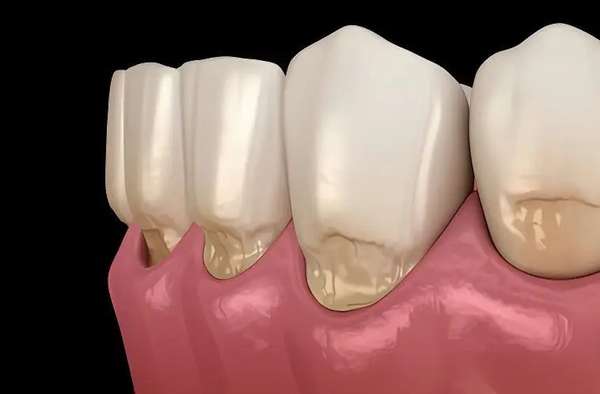 牙齿楔状缺损一定要补牙吗？