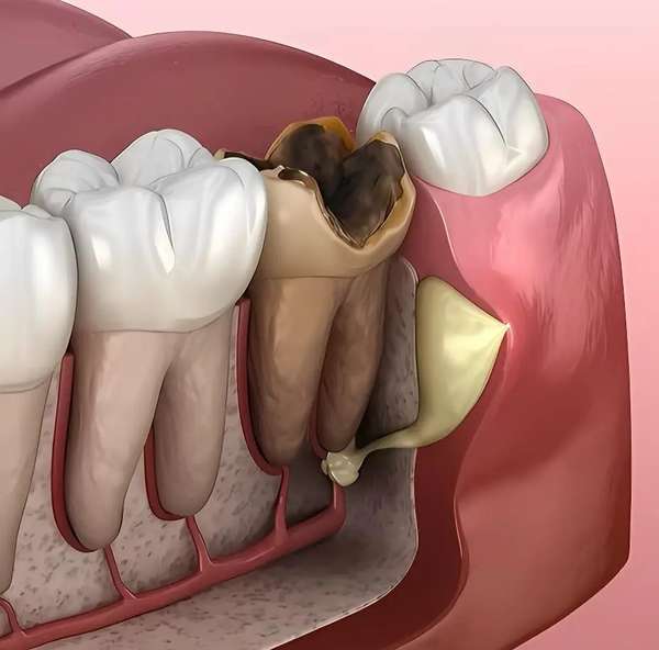 牙齿受伤最佳补救方法(牙齿受伤牙断了怎么办？这些要点快收藏！)