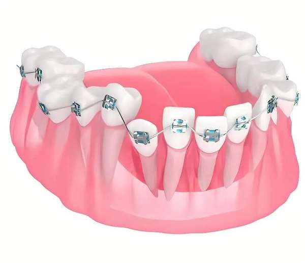 儿童牙齿矫正为什么要趁早(儿童牙齿矫正一定要趁早做吗？)