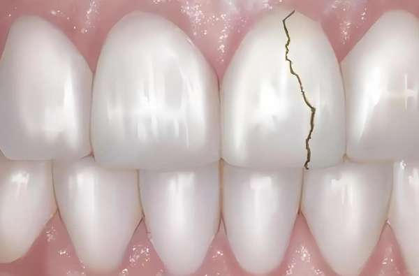 为什么牙齿会莫名其妙疼？