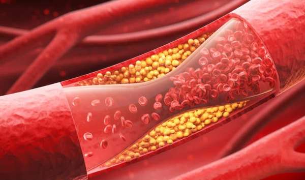 高胆固醇不能吃坚果吗(高胆固醇者不能吃坚果？医生：这5种食材最能降胆固醇)