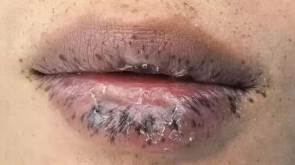 嘴唇突然出现很多纹路怎么回事(嘴唇出现这种变化，竟是体内有癌！男子瞬间“五雷轰顶”，母亲也因此病去世)
