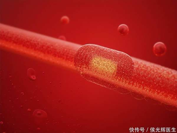 60岁医生突发心梗去世(60岁老人突发中风，医生：这些心血管问题可能是中风前兆，别忽视)