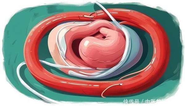 肠梗阻前兆(肠梗阻悄悄来袭，医生提醒：出现3种症状，可能是肠道在“求救”)