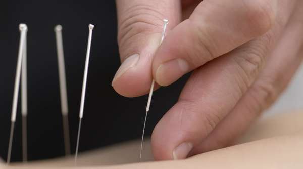 针灸有效性的证明(实验证明针灸镇痛有科学依据，针灸到底科学吗？)