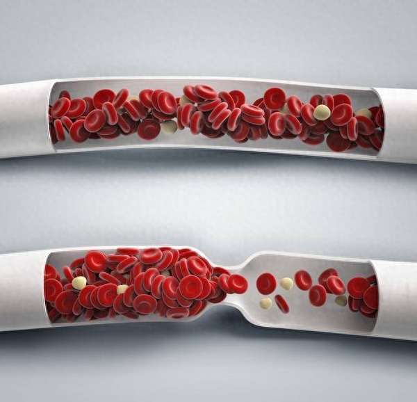 静脉曲张和静脉血栓有什么区别？