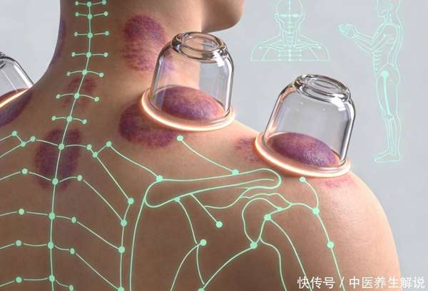 拔罐三大禁忌穴位图(这3个拔罐误区别再碰，损气又耗血，不少人天天罐，越罐越乏力)