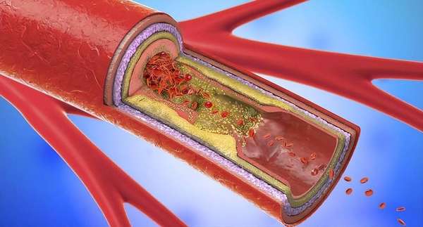 冠心病千万别碰的五种食物(冠心病患者冬季别碰羊肉？医生建议多吃这几样保健康)