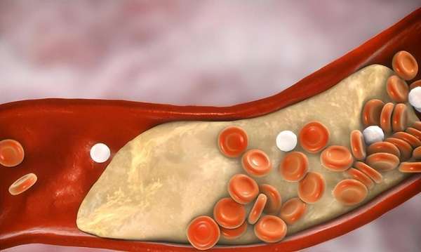 荔枝是血脂催化剂吗(荔枝是血脂催化剂？医生建议想血脂正常，3种水果少吃)