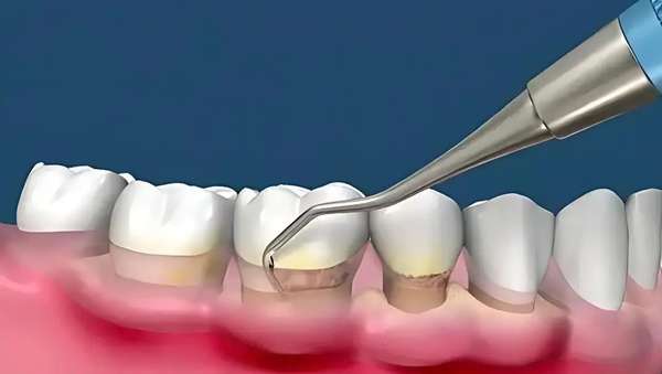 牙周病刮治视频(牙周病刮治全知道)
