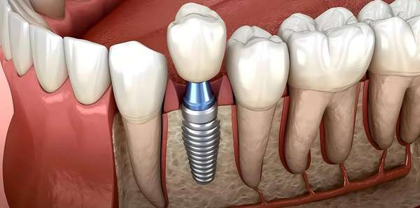 牙冠修复和种植牙哪个更好(牙冠修复与种植牙：你真的了解吗？)