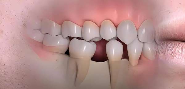 拔牙后不种牙空着有什么影响(拔牙后一直空着不种牙可行吗？)