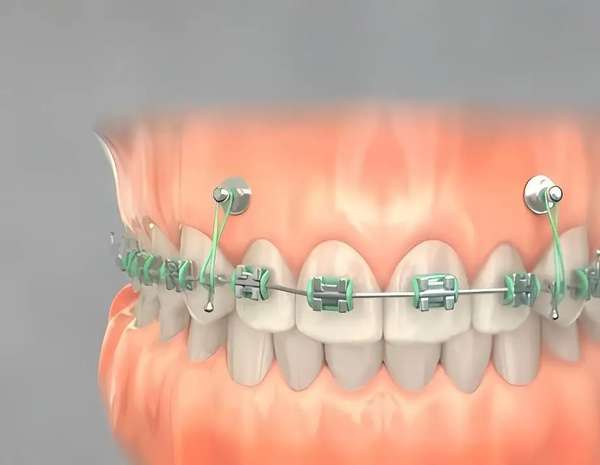 牙齿矫正对年龄有要求吗(牙齿矫正怕太晚？不同年龄应对指南)