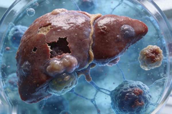 酒精肝严重了会怎么样(酒精肝越拖越糟？别以为是代谢差，或是这3个习惯伤肝)