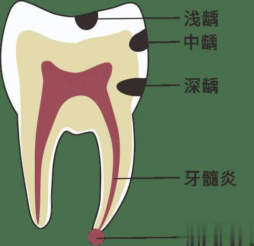 牙齿磨小会引起牙髓炎吗(牙齿发炎硬扛？揭开牙髓炎、牙周炎无法自行修复深层原因)