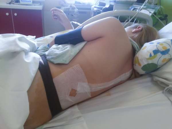 剖宫产术后疼痛难忍怎么办(剖宫产后疼痛无比？麻药不是万能的，还有这些方法……)