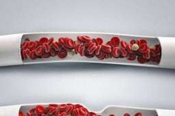 静脉曲张和静脉血栓有什么区别？