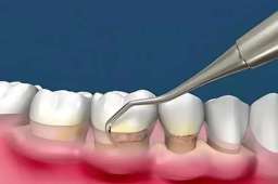 牙周病刮治全知道