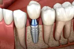 牙冠修复与种植牙：你真的了解吗？