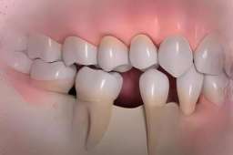 拔牙后一直空着不种牙可行吗？